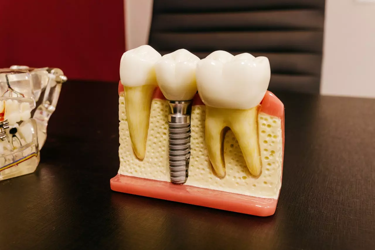 Dental implants teeth