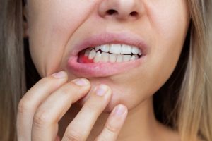 swollen gums