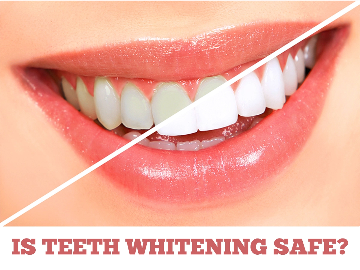 Is Teeth Whitening Safe