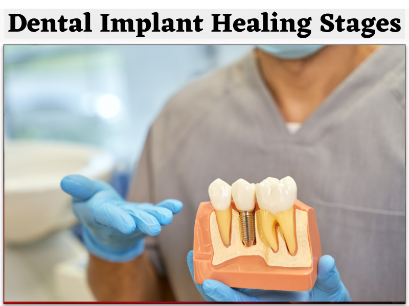 Dental Implant Healing Stages