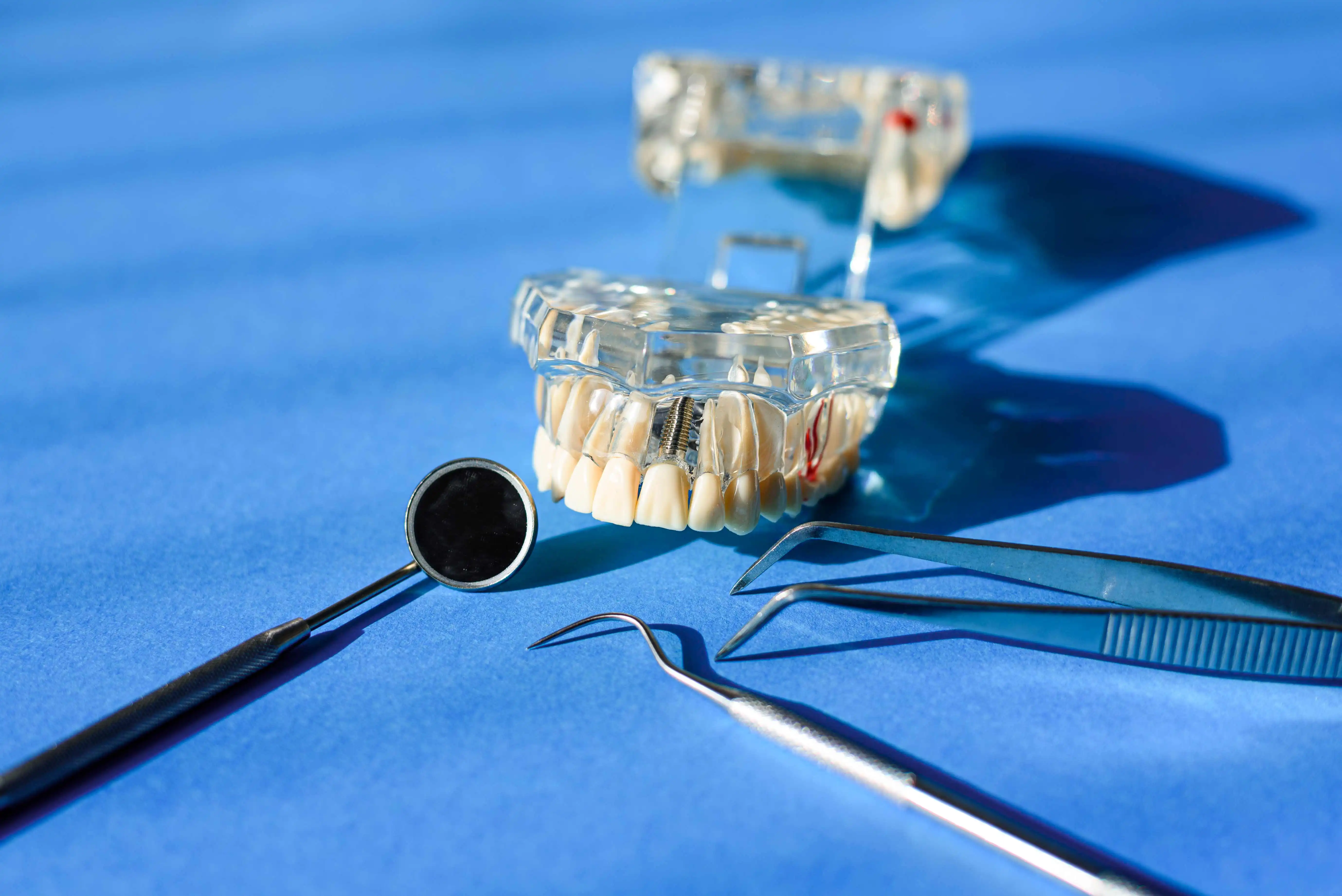 The Structure of A Dental Implant