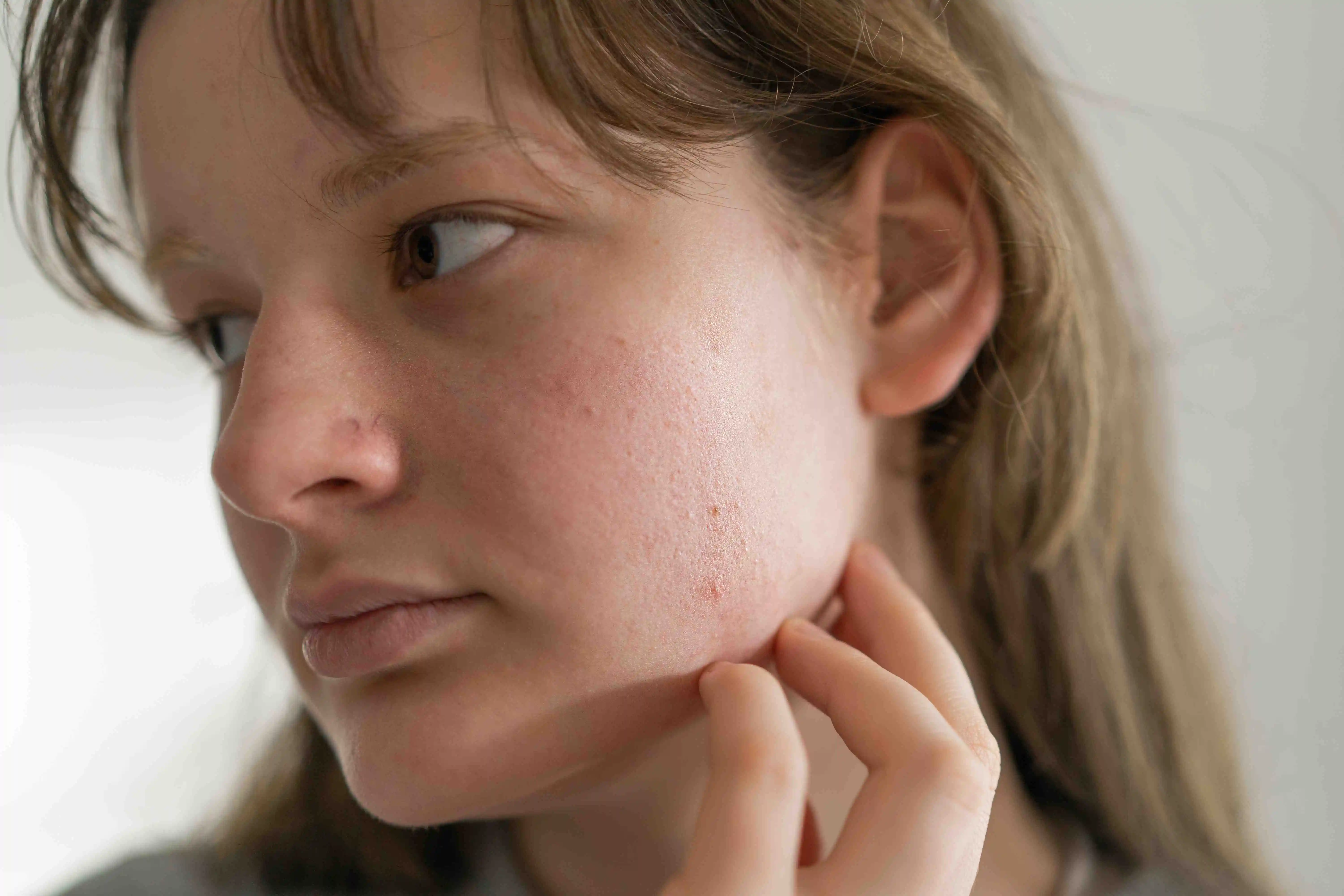teenage girl with a Facial Swelling
