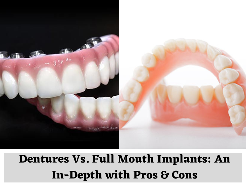 Dentures Vs. Full Mouth Implants: An In-Depth Pros and Cons