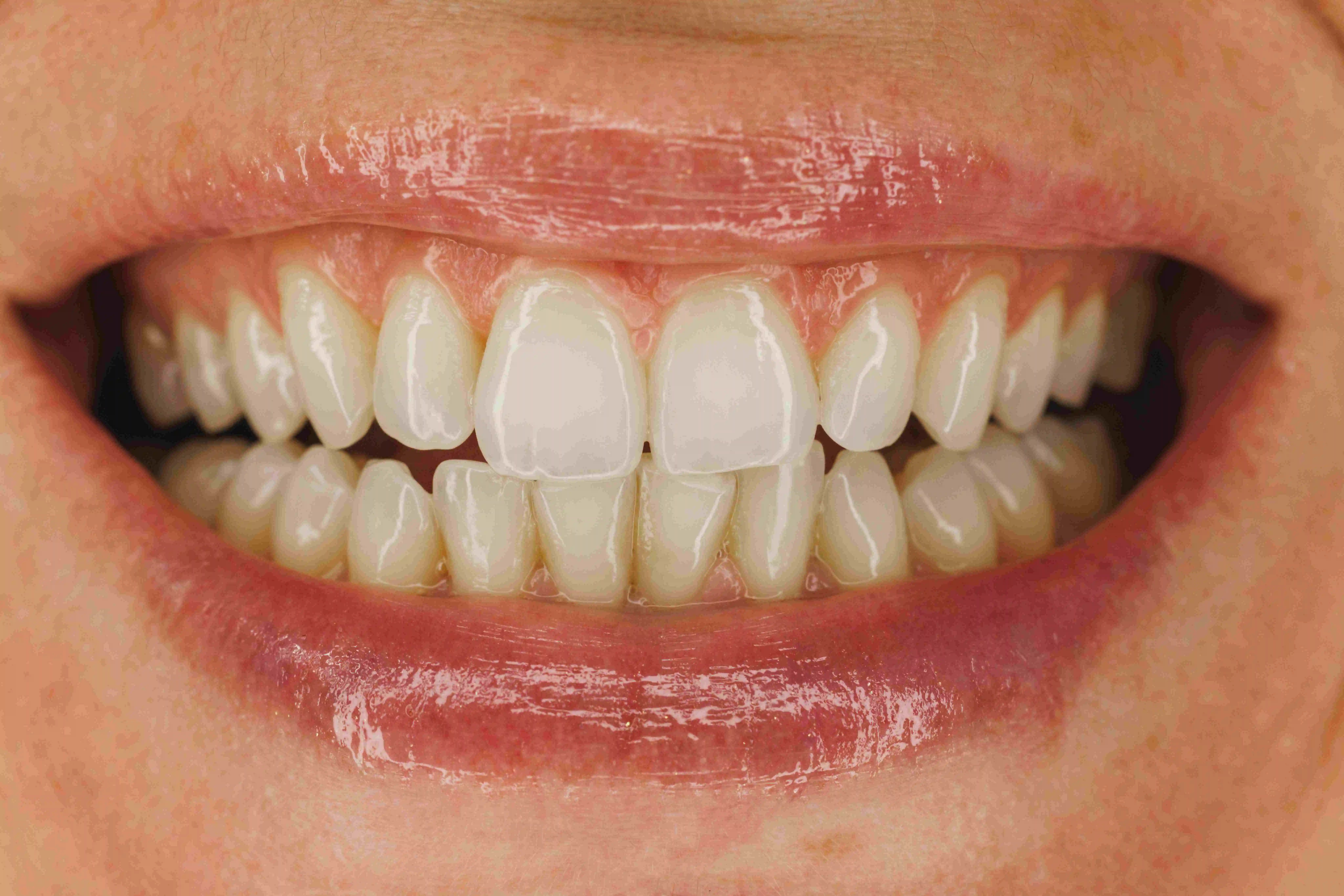 What is the Safest Way to Whiten Teeth