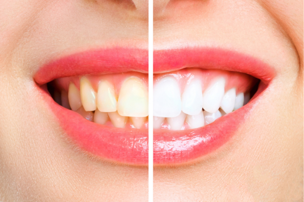 Reasons for Teeth Whitening