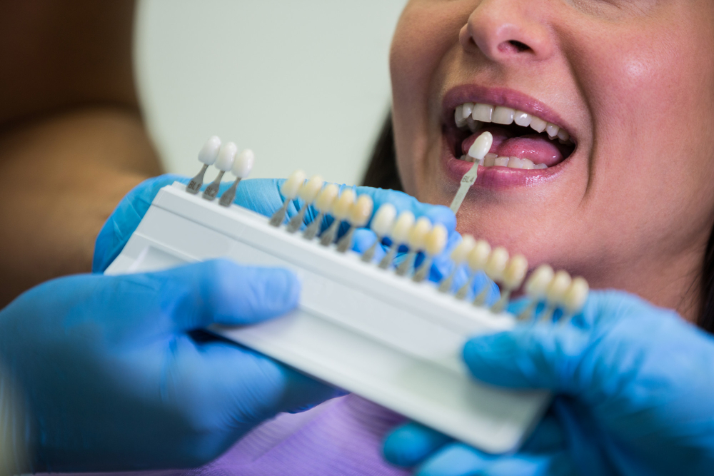 are veneers permanent