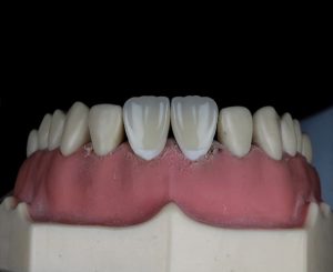 dental cap vs crown