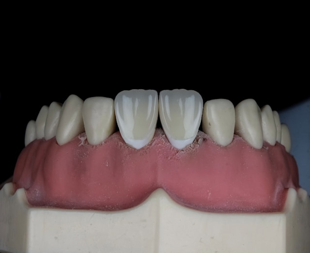 dental cap vs crown