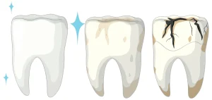 tooth decay treatments