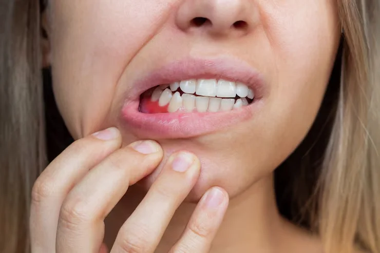 early stages of gingivitis