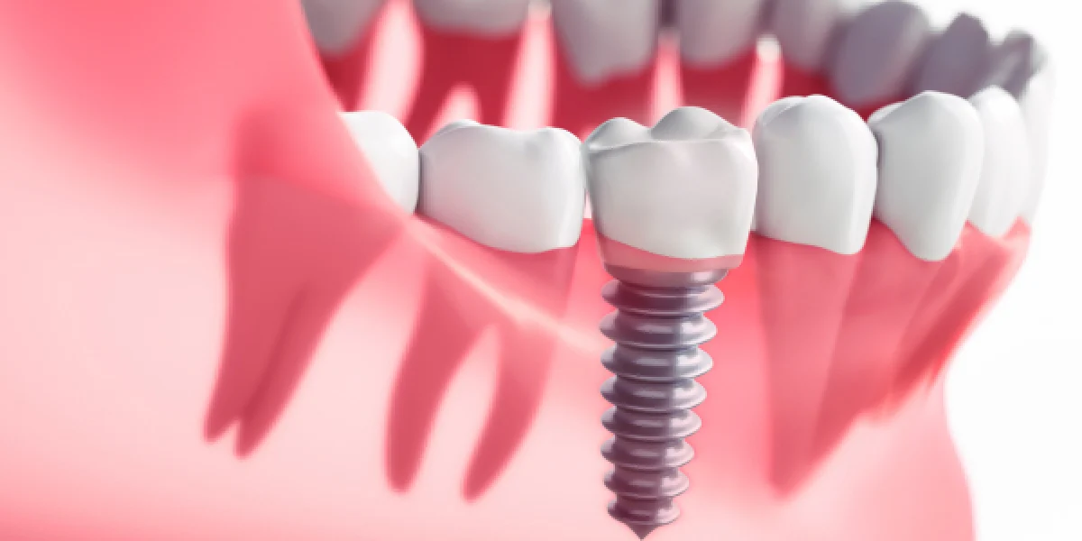 Do Dental Implants Last Forever
