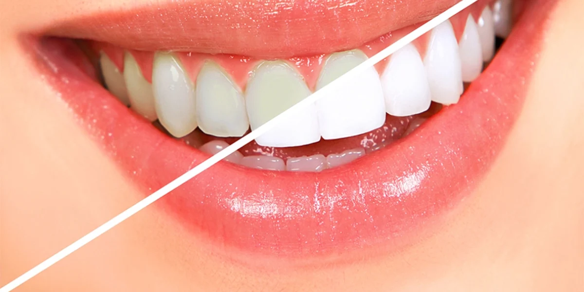 Is Teeth Whitening Safe