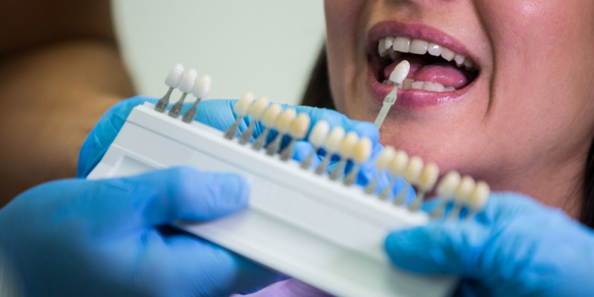 are veneers permanent