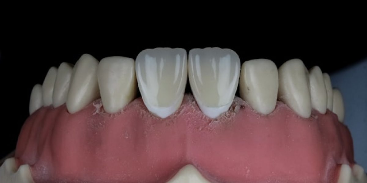 dental cap vs crown