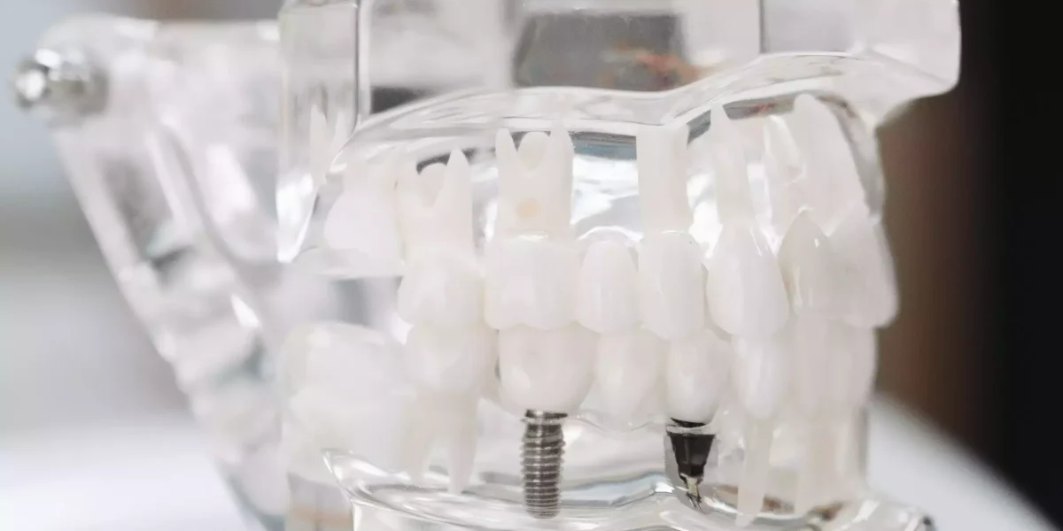 Dental Implants