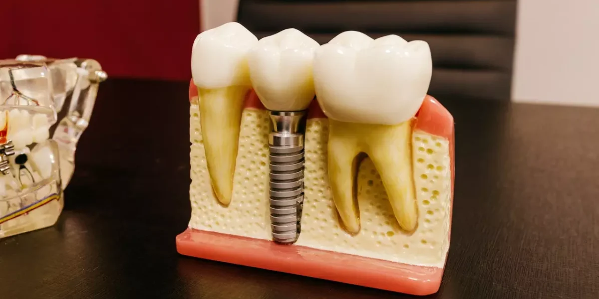Dental implants teeth