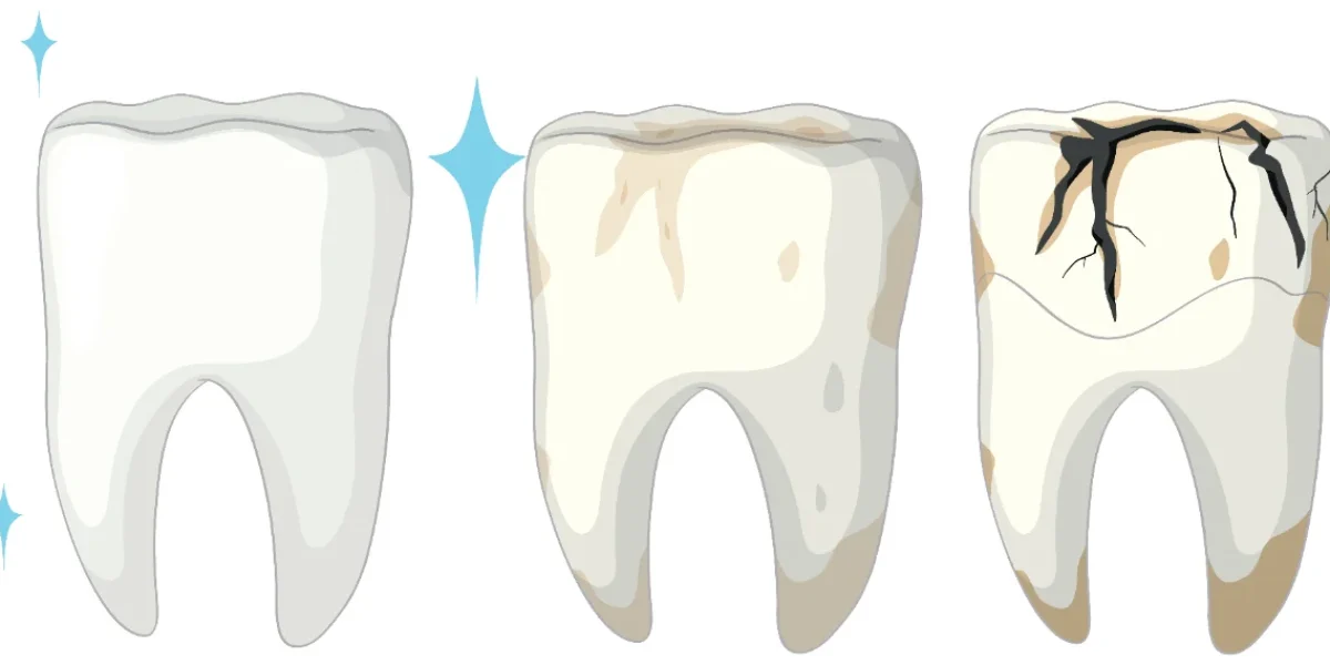tooth decay treatments